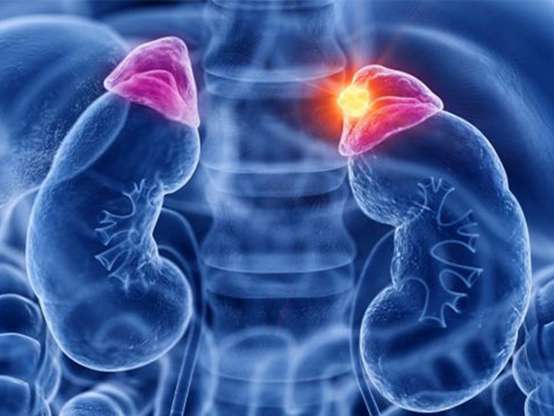 چگونگی سرطان آدرنال