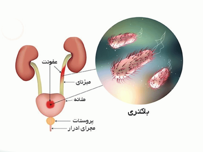 عفونت-ادراری چیست؟