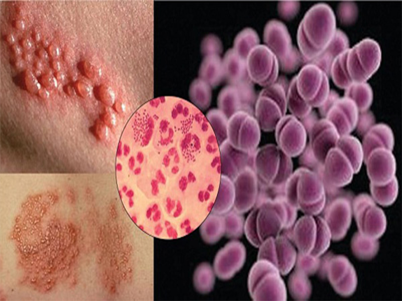 بیماری سوزاک چیست؟