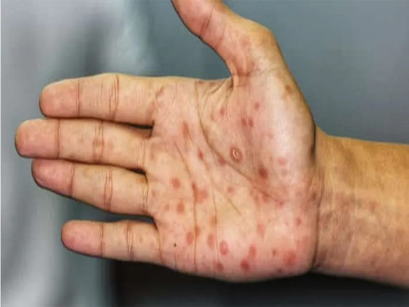 سیفلیس چیست؟