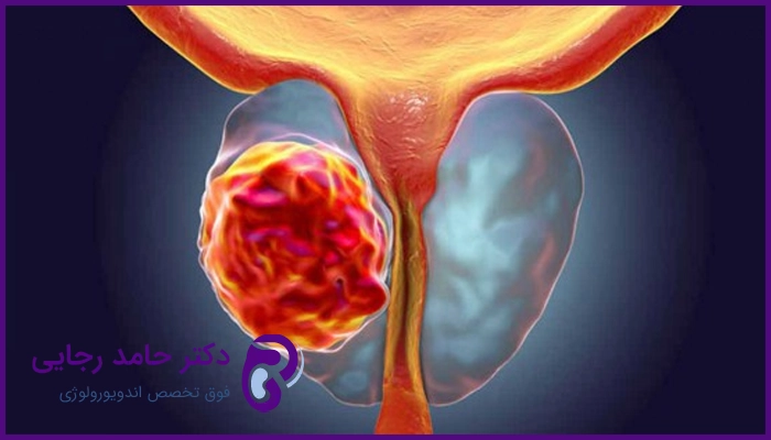 سرطان پروستات چه علائمی دارد؟