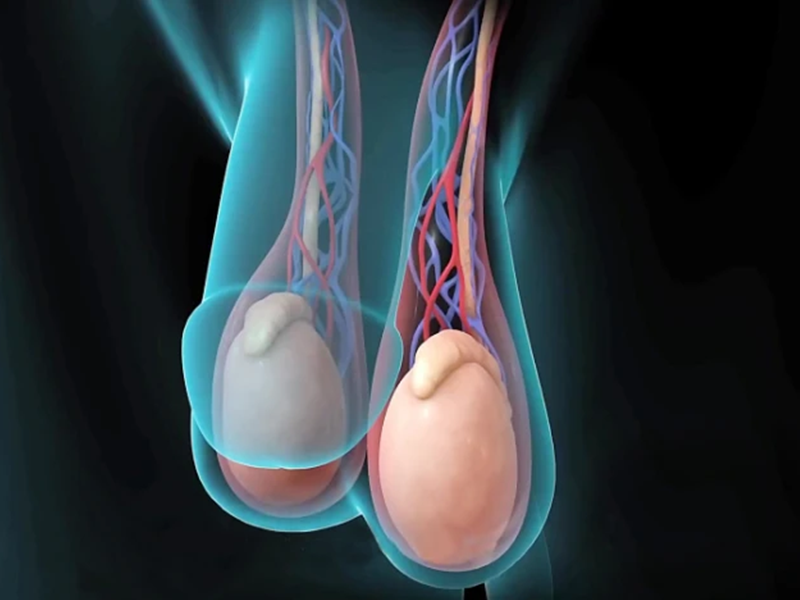 انواع گرید واریکوسل