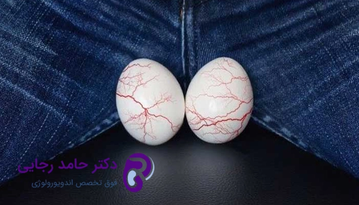 تشخیص واریکوسل گرید 3