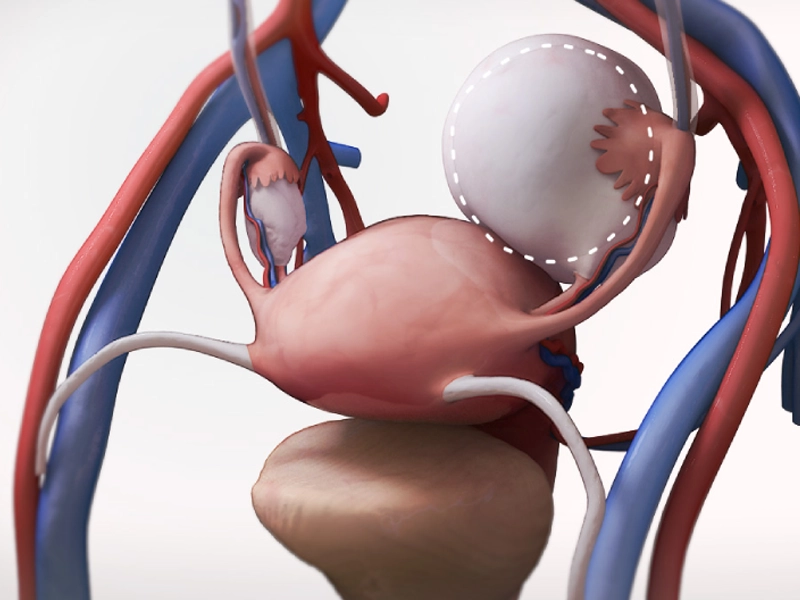 جراحی سیستکتومی یا برداشتن مثانه